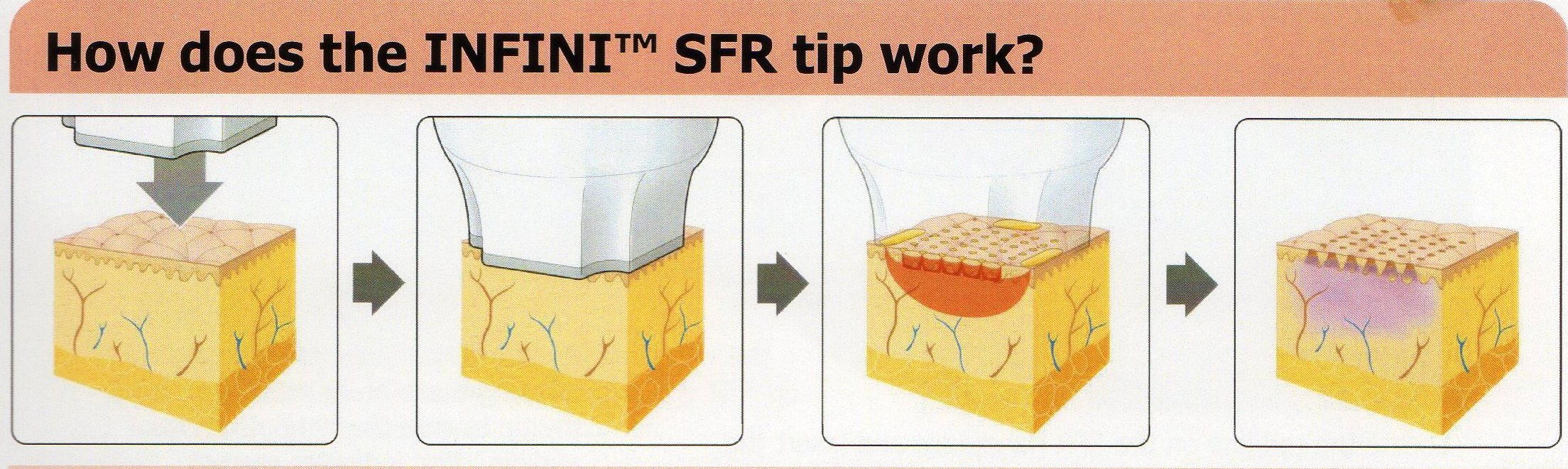 SFR TIP